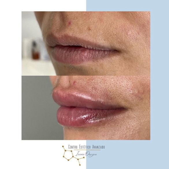 labios de mujer antes y después de tratamiento